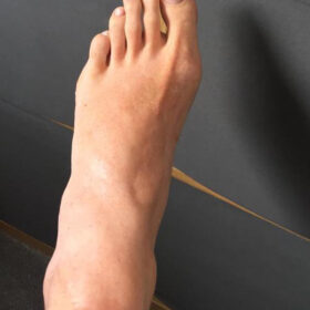 Swollen foot
